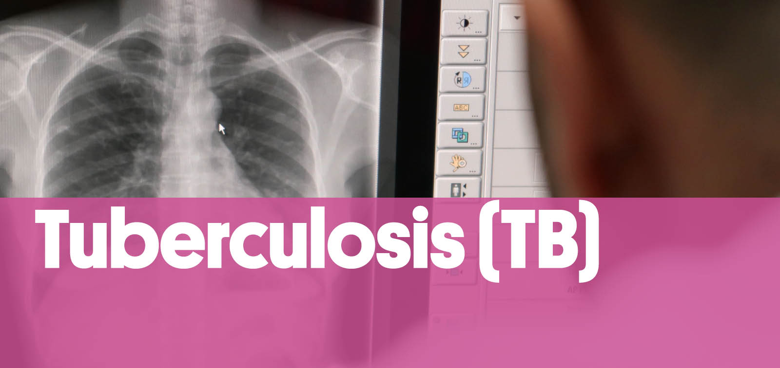 Tuberculosis Tb E Infecciones Por Micobacterias Tuberculosis Tb And Mycobacterial Infections Programa Isglobal