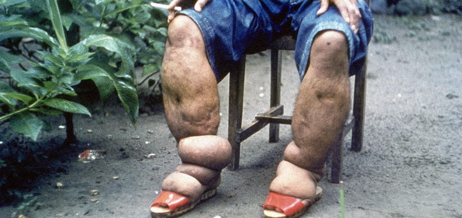 Elephantiasis of leg due to filariasis, in Luzon, Philippines.