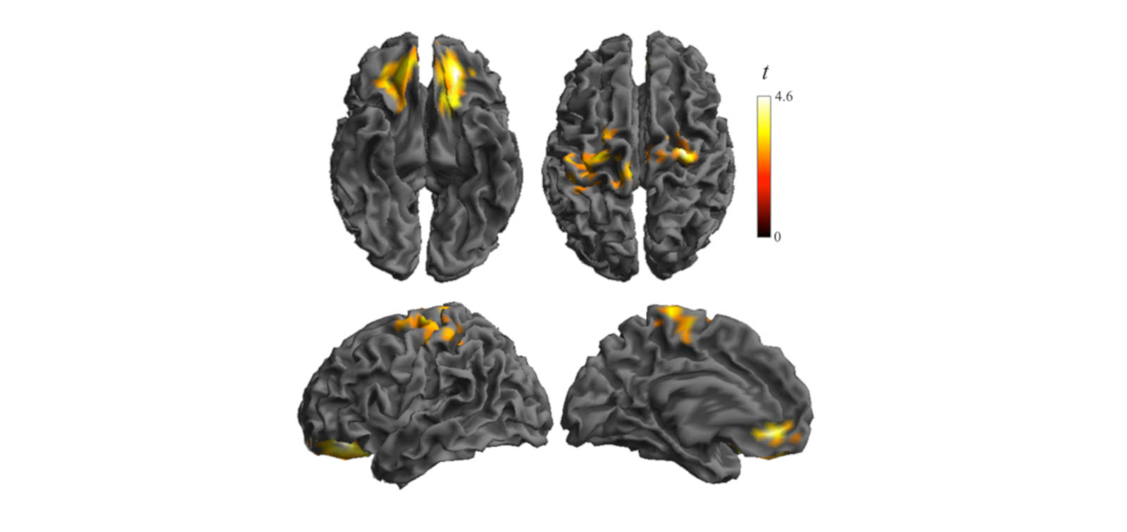 Brain Alterations Detected in Obese Children. Photo by Hospital del Mar.